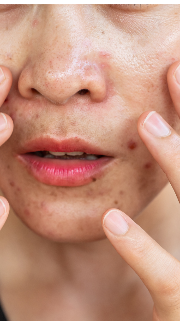 Hyperpigmentation/Dark spots