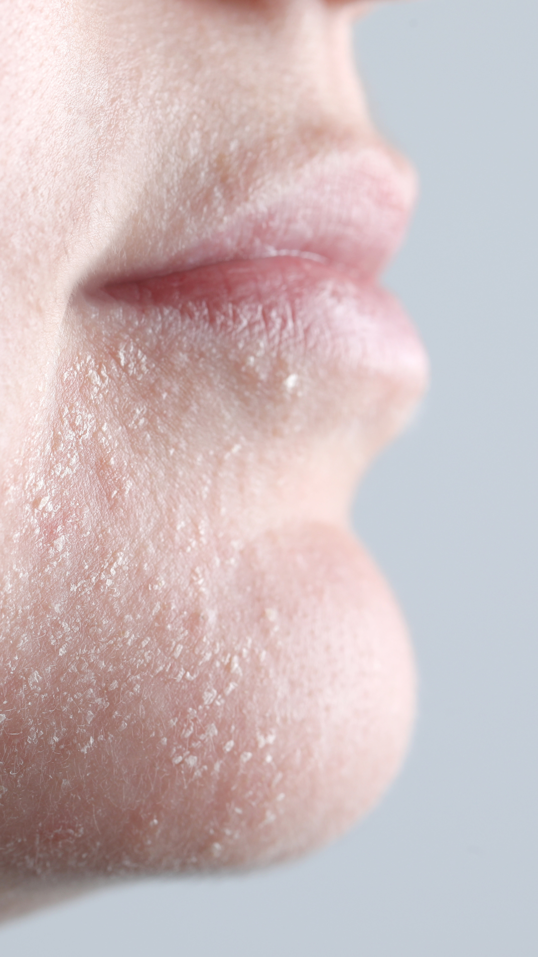 Dry skin